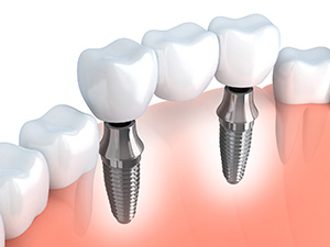 advanced-procedures-bridges