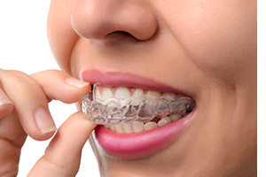 cosmetic-procedures-invisalign