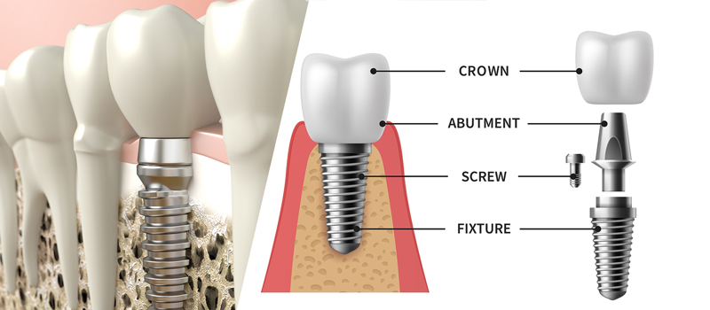 Dental-implant-NorthwestChicago Dental